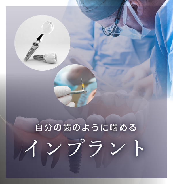 第二の永久歯・インプラント治療・ストローマン
